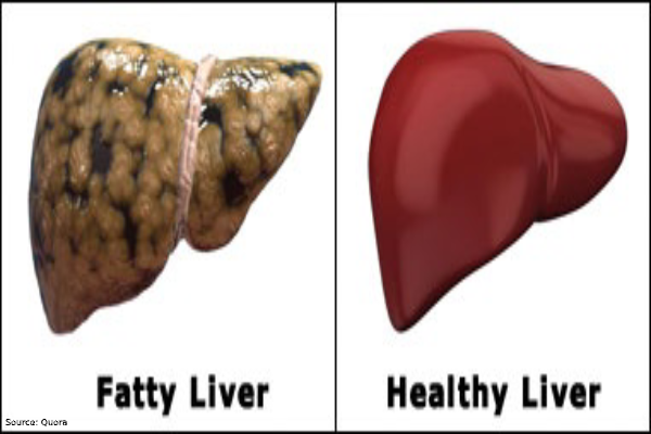 Fatty Liver: What is it and how to overcome it? --KIMSHEALTH Oman Hospital
